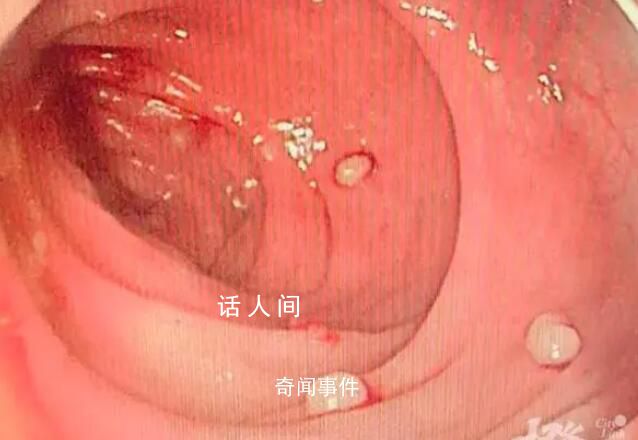 14岁男孩肠道里查出20多颗&ldquo;珍珠&rdquo; 爸爸爷爷均因此去世