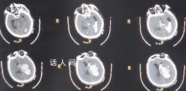男子喂猪时晕倒 遭家猪啃食下半身