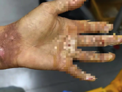 [快讯]3岁男童掉进炭火堆全身85%烧伤 父母崩溃求助：救救孩子