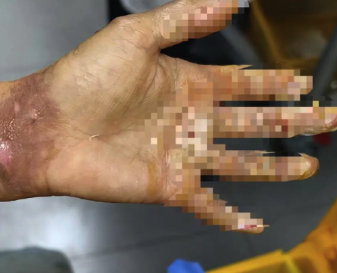 3岁男童掉进炭火堆全身85%烧伤 父母崩溃求助：救救孩子