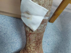 [快讯]男子腿痒没在意 变成“树皮腿” 干燥性湿疹继发丹毒