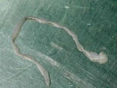 [快讯]女子脑内取出8厘米长活虫 民间偏方惹祸