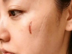 杨蓉晒烫伤后疤痕恢复照!!(图）