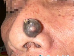 大爷鼻子上长了小疙瘩竟确诊是癌 不疼不痒却暗藏危机[快讯]